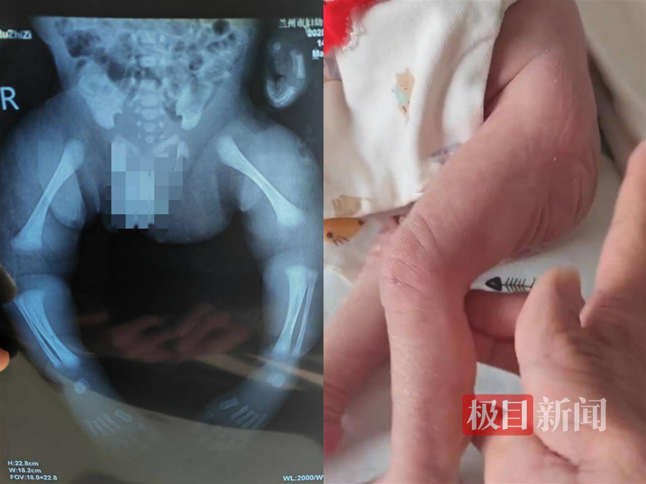 二胎出生查出先天性病症或落下残疾<strong></p>
<p>币圈视频</strong>，残疾父母称医院产检漏检、未尽告知义务，医院及医调委回应