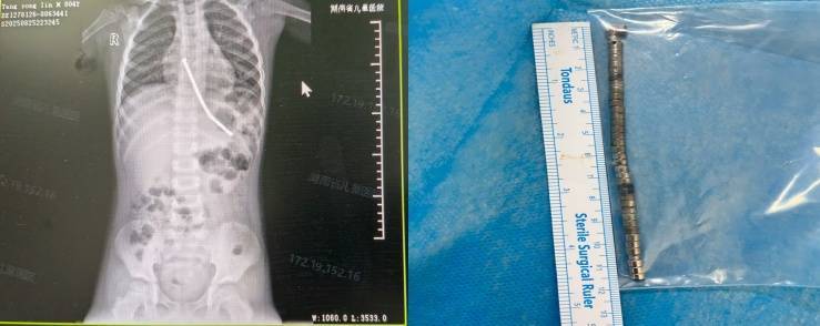 整整40颗<strong></p>
<p>校币</strong>！湖南3岁男童身体里取出……医生紧急提醒