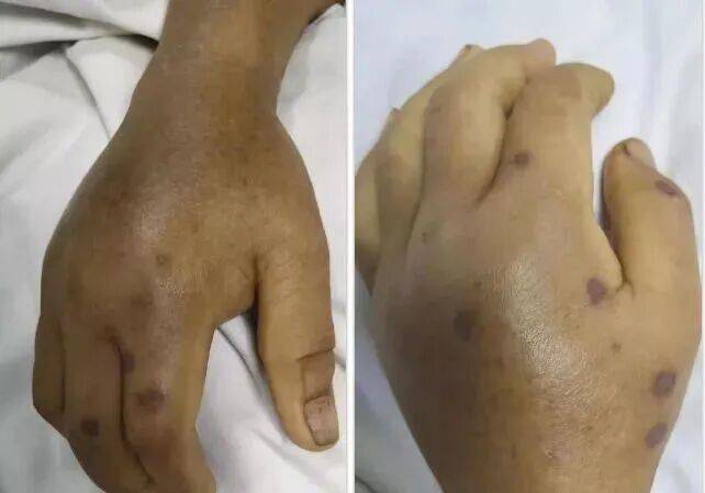 深圳一市民突遭马蜂围袭！已进入高发期<strong></p>
<p>币圈信息</strong>，千万别招惹！