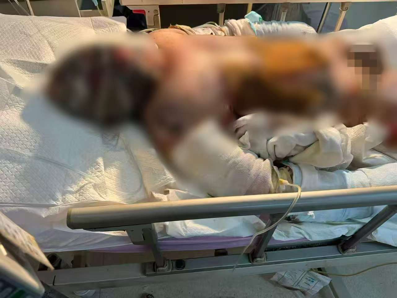 父子在哈尔滨一亲戚公司上班遇爆炸全身烧伤<strong></p>
<p>币圈信息</strong>，治疗花费近百万公司拒赔偿？亲戚回应