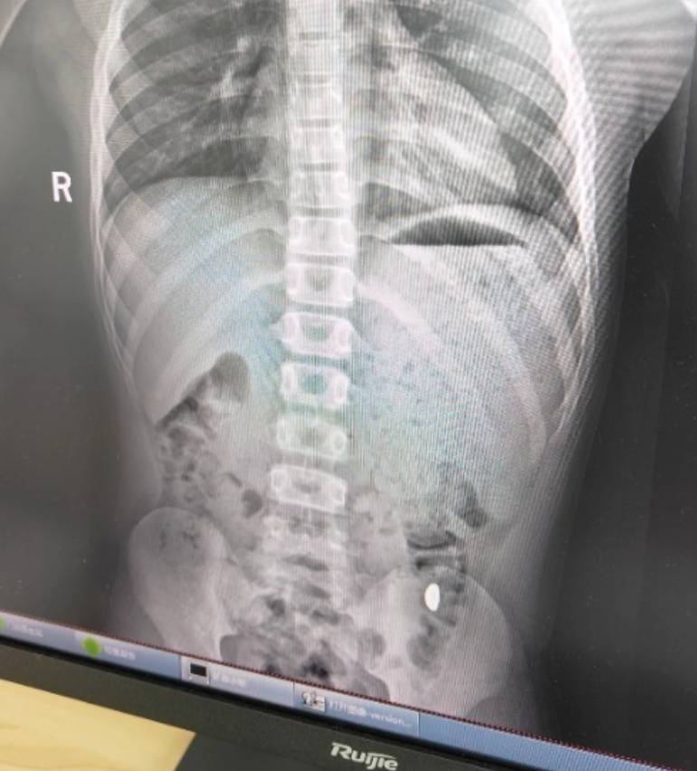 “熊孩子”误吞10克重金豆<strong></p>
<p>老币兑换价格表</strong>，妈妈：天天叮嘱他不要在外面拉屎