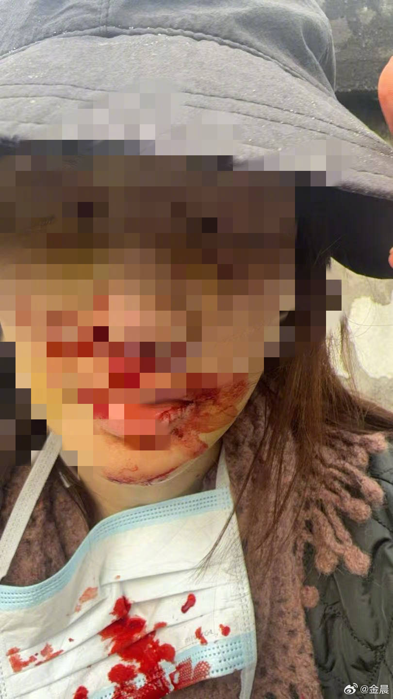 警方发布警情通报后<strong></p>
<p>炒币赔钱了</strong>，金晨晒脸部受伤照片并发文道歉